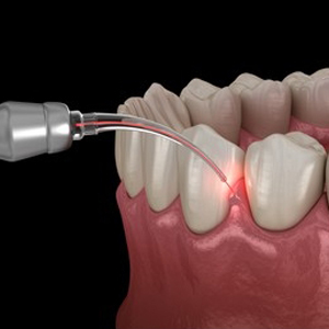 Laser Dentistry in Karimnagar